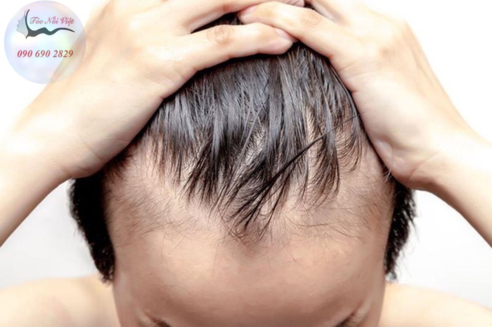 7 kiểu tóc cho người hói đỉnh đầu nam che đi khuyết điểm hiệu quả